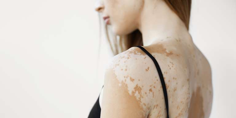 vitiligo chur mediclever